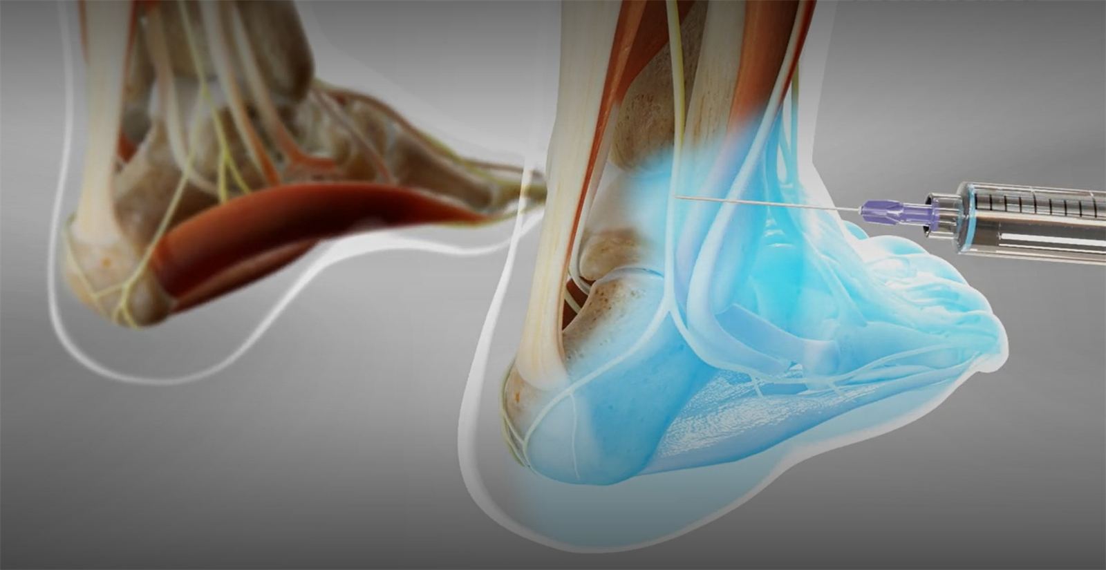 Ankle Nerves Pulsed Radiofrequency and Block