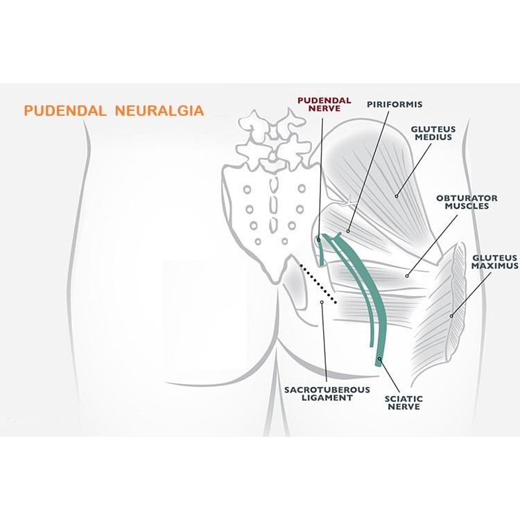 Pudendal Nerve Pulsed Radiofrequency and Block